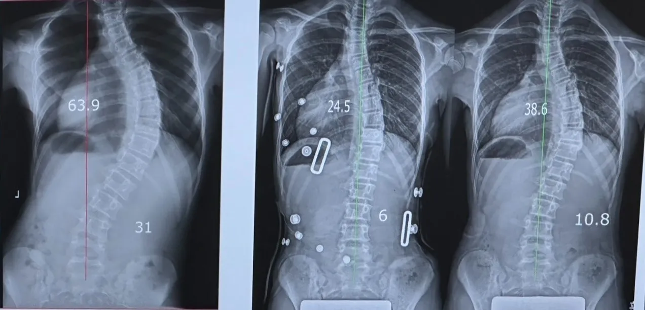 【東京都大田区在住】小学6年生の側弯症が3ヶ月で30度改善した実例