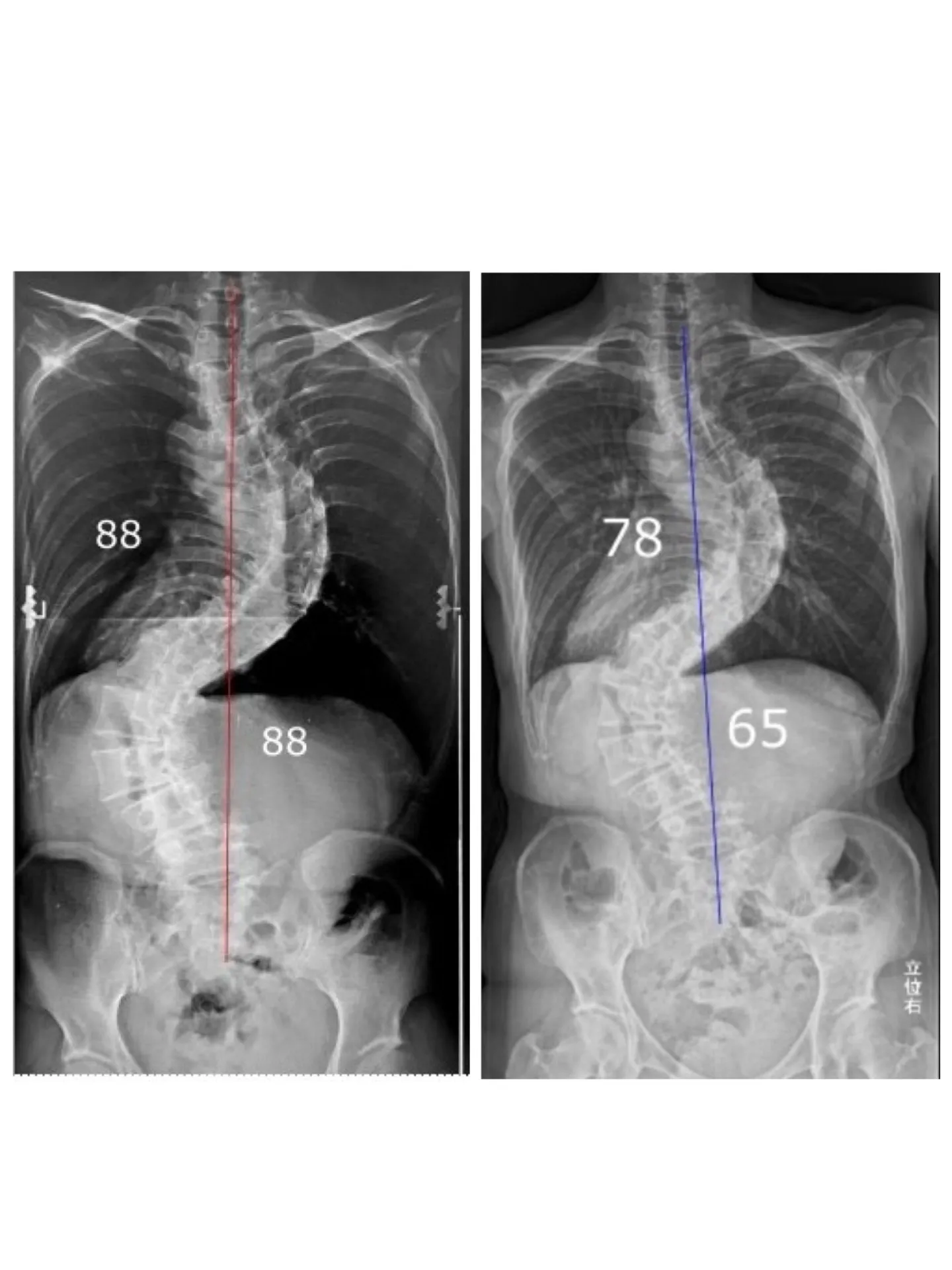【神奈川県横浜市在住】50代女性　コブ角88度の側弯症が23度改善した事例
