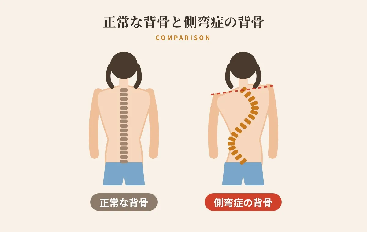 正常な背骨と側弯症の背骨の比較イラスト（肩の高さの左右差）