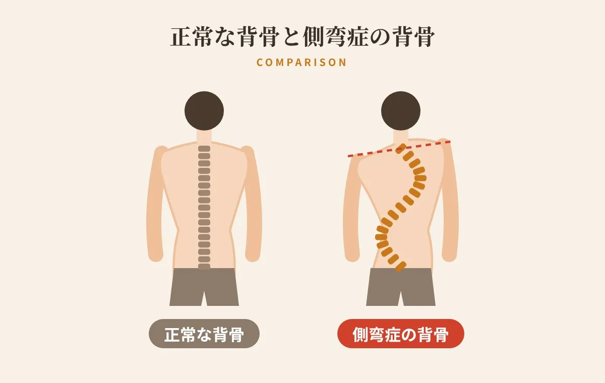 正常な背骨と側弯症の背骨の比較イラスト